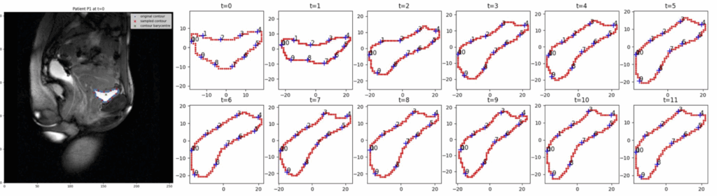 Représentation d'une image IRM avec un contour segmenté de vessie à gauche. A droite : représentation de la déformation d'un contour échantillonnée temporellement